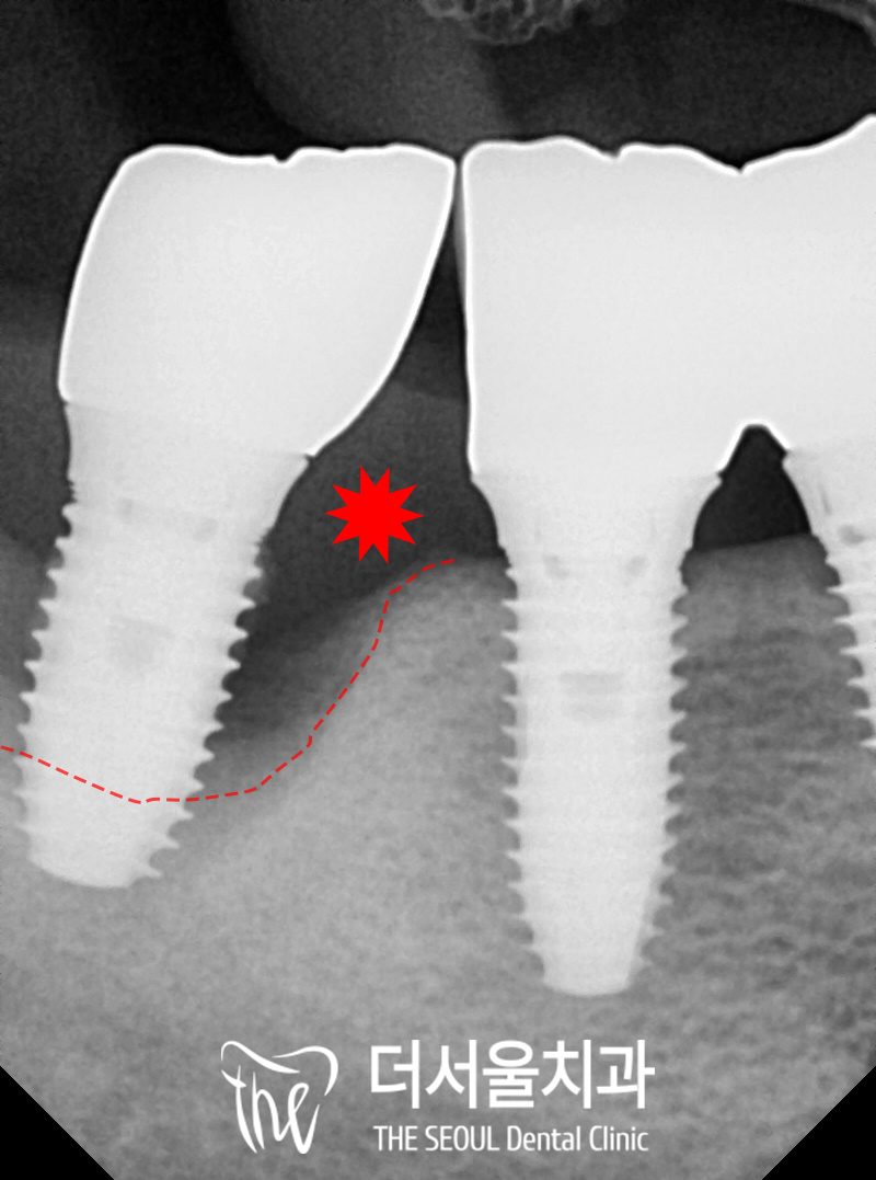 Close-up dental X-ray of two implants, with the bone level drawn in as a dashed red line and a defect in the bone marked with a red asterisk