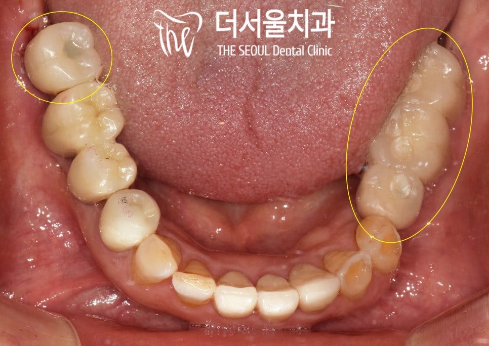 Intraoral photograph of the lower teeth, with the back teeth on both sides circled in orange