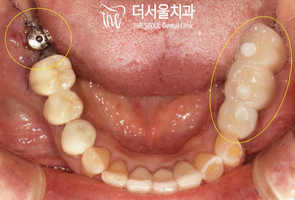 Intraoral photograph of the lower teeth with an implant component visible at the back on one side