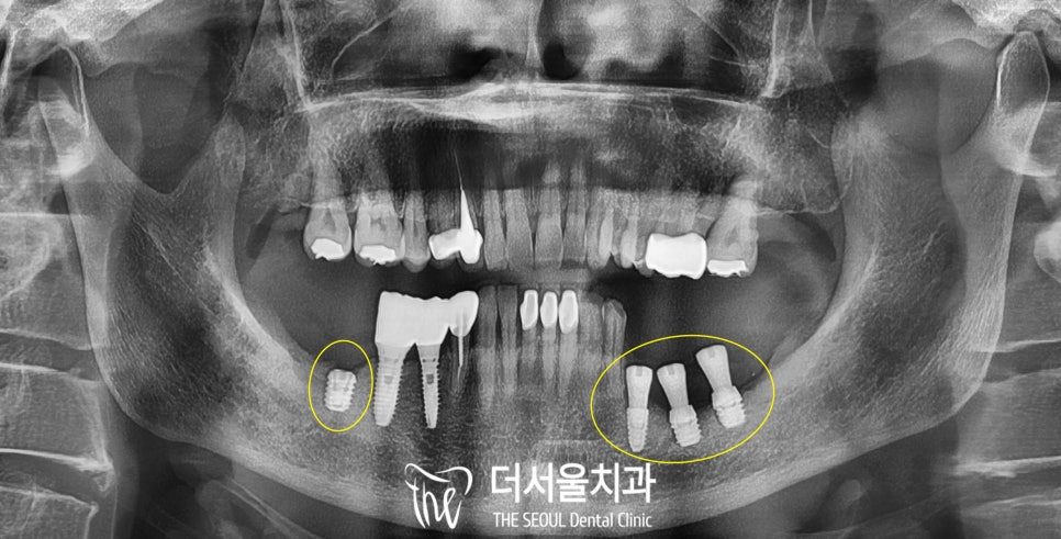Implant Revision in Korea: Why Implants Fail and What It Costs