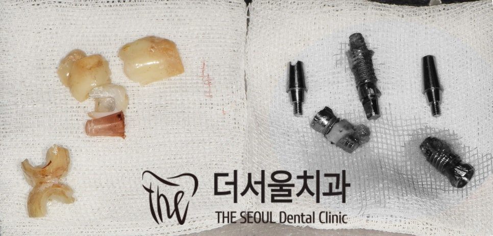 Implant fixtures and crowns laid out on gauze after being removed from the jaw