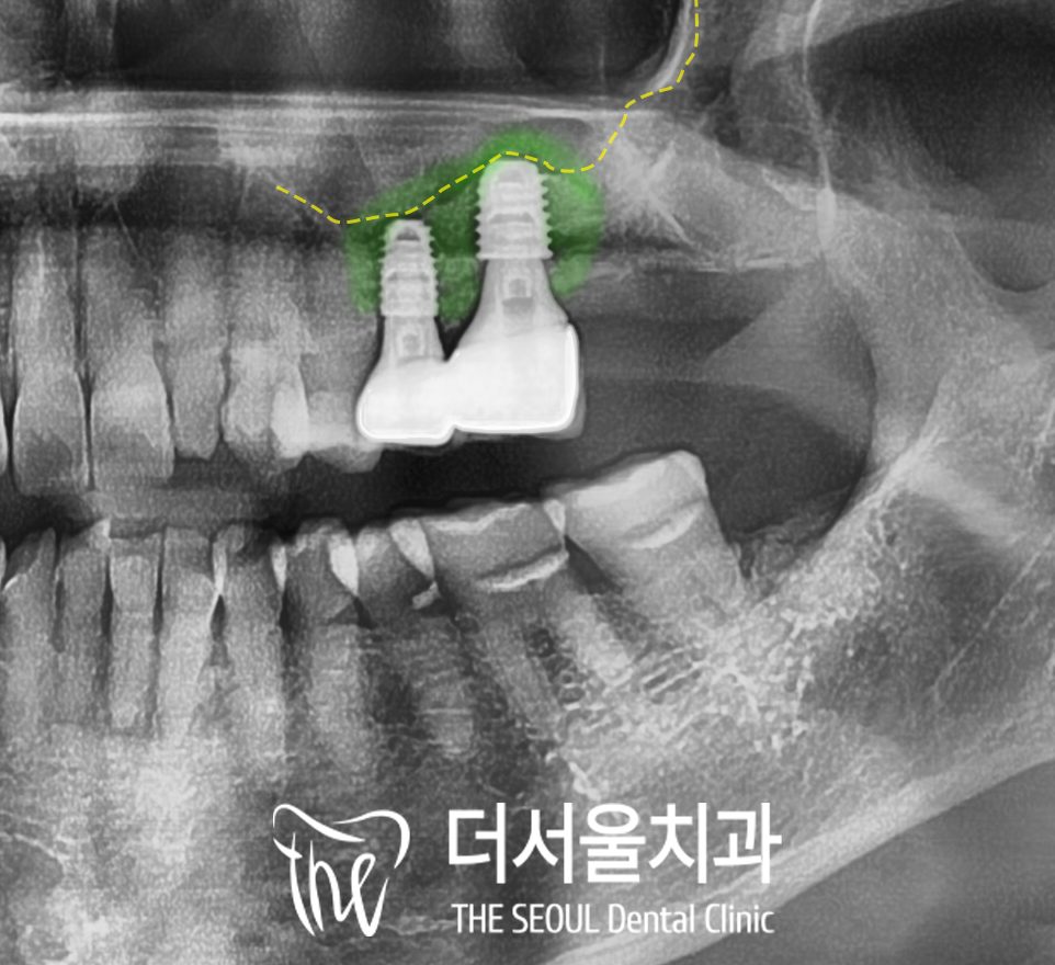 Guided Implant with Sinus Lift in Korea: Pain and Recovery