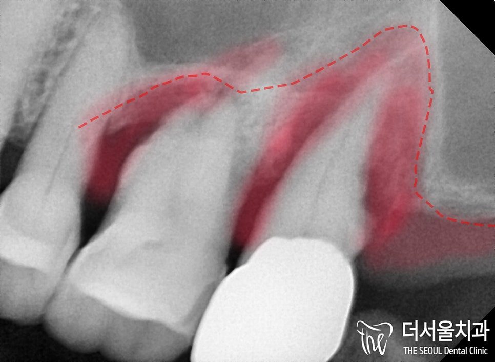 Close-up dental X-ray with the sinus above the upper back teeth outlined and shaded in red