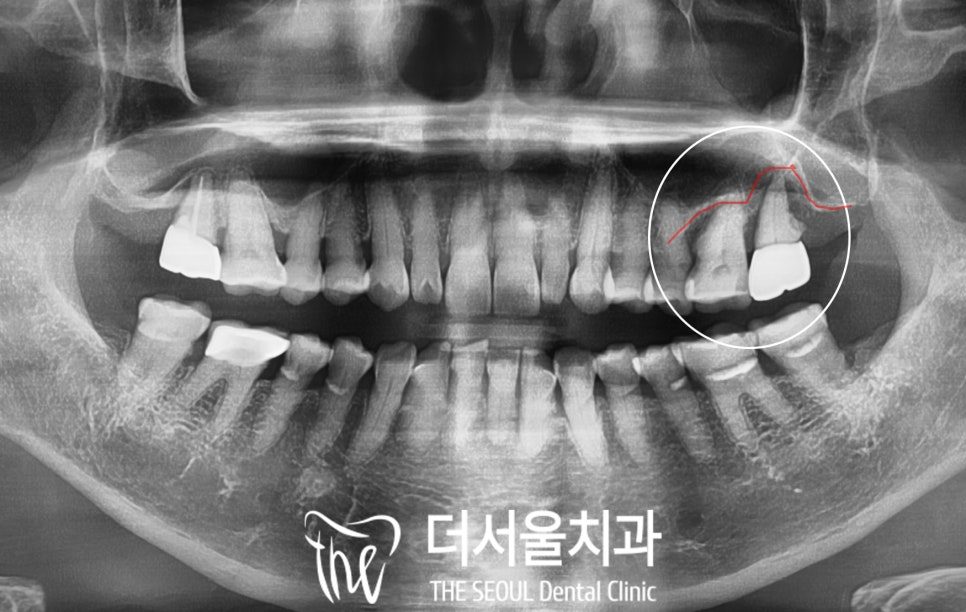 Panoramic dental X-ray with the upper back area circled in white where an upper molar is missing