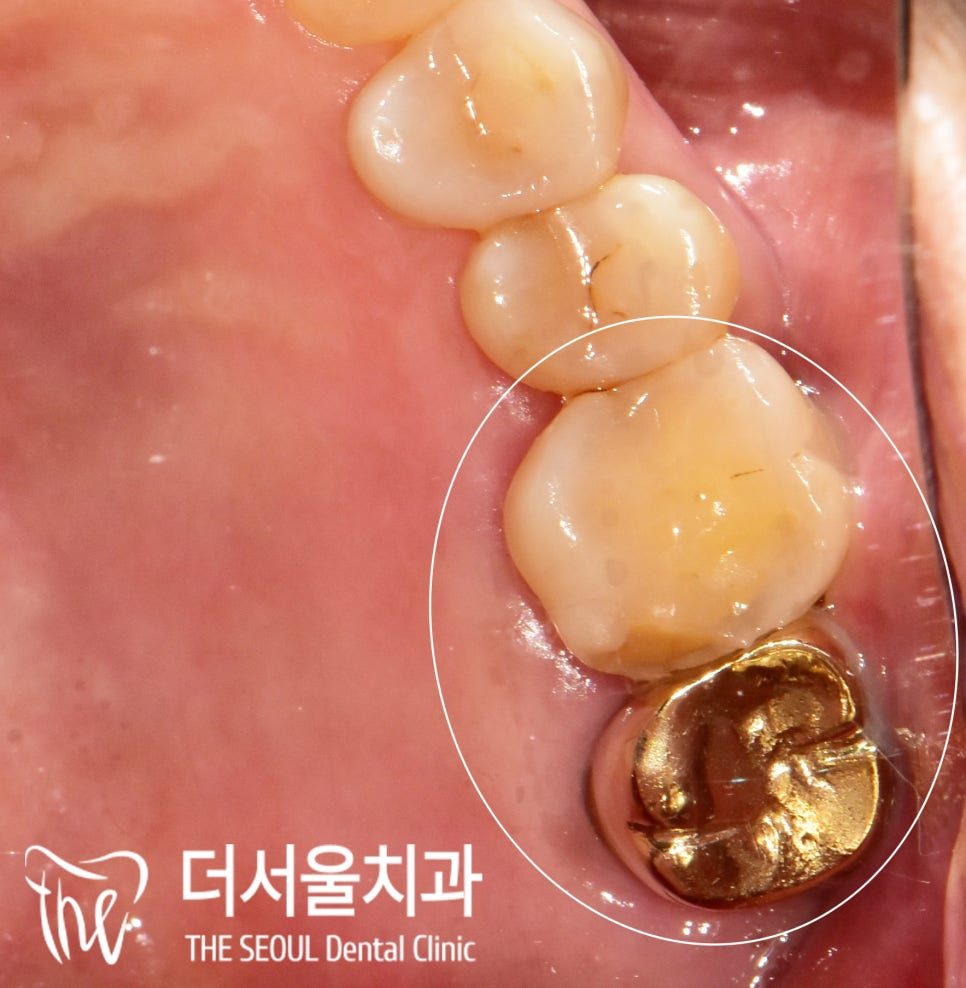 Intraoral photograph of the upper back teeth with one tooth circled, next to a gold crown
