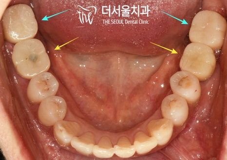Intraoral photograph of the lower arch seen from above, with coloured arrows pointing to back teeth carrying tooth-coloured restorations