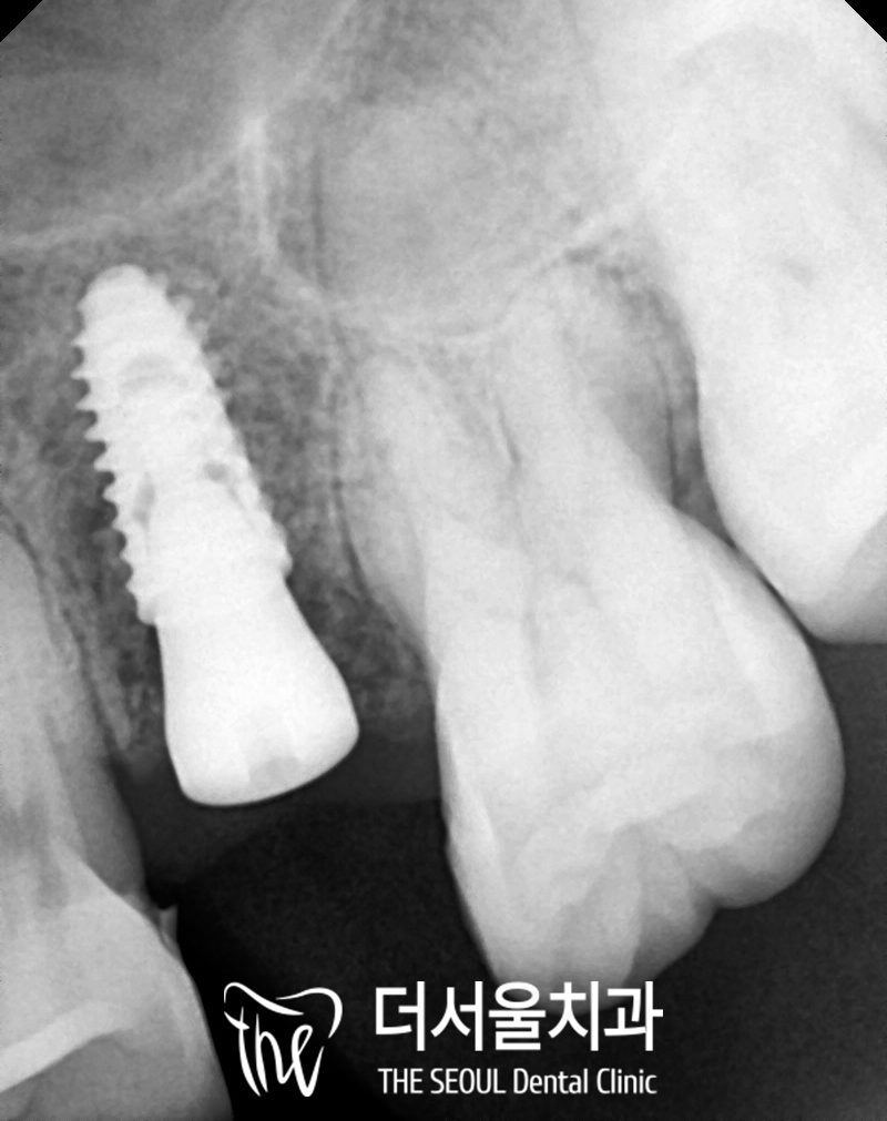 Close-up dental X-ray of a single implant in the upper jaw with its crown fitted, next to a natural molar