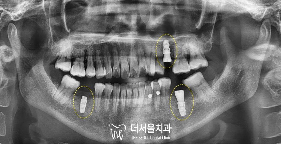 Guided Implants and Cavities Treated Together in Korea