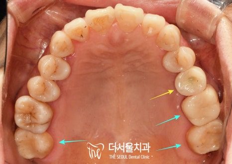 Intraoral photograph of the upper arch seen from below, with coloured arrows pointing to the back teeth where decay was treated