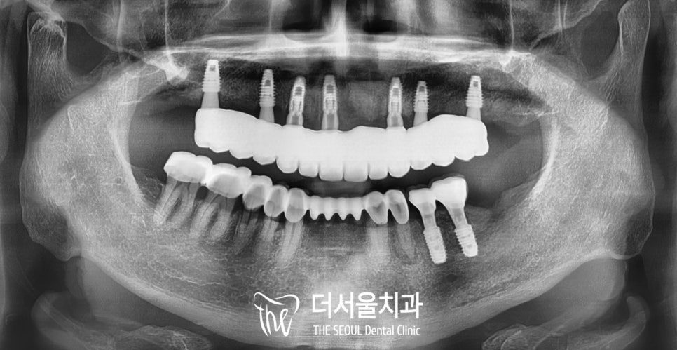 Full-Arch Implants in Korea: Process, Cost and Same-Day Teeth