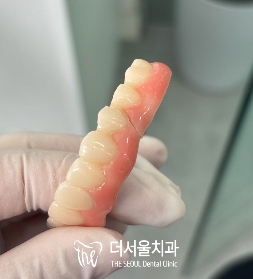 A gloved hand holding a full-arch temporary prosthesis made of tooth-coloured acrylic