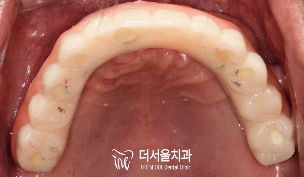 Intraoral photograph of the finished full-arch prosthesis fitted in the upper jaw