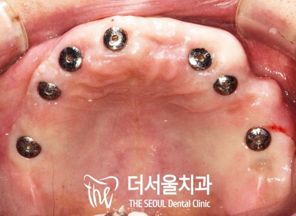 Intraoral photograph of an upper jaw with six implant abutments fitted around the arch