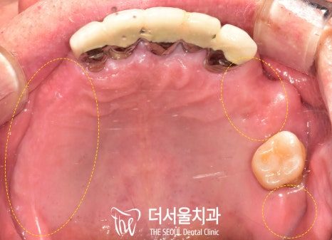 Intraoral photograph of an upper jaw with only a few broken and decayed teeth remaining