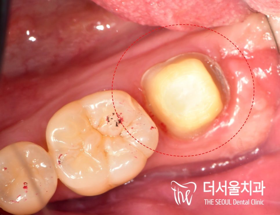 Intraoral photograph of a back tooth with a gold-coloured crown, circled, with reddened gum around it