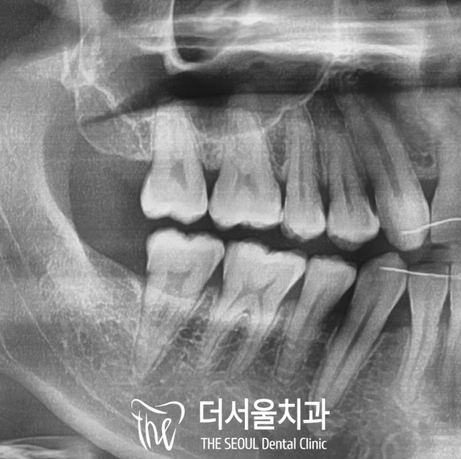 Cracked Tooth and C-Shaped Canals: Root Canal and Crown