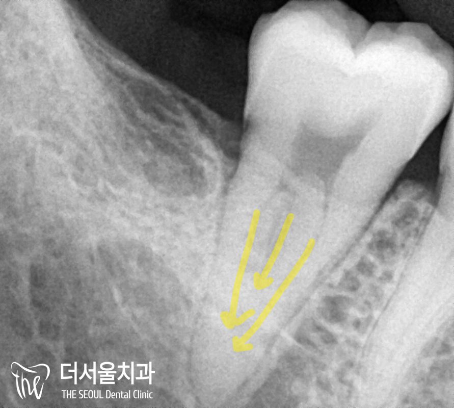 Close-up dental X-ray with yellow arrows pointing down the roots of a molar