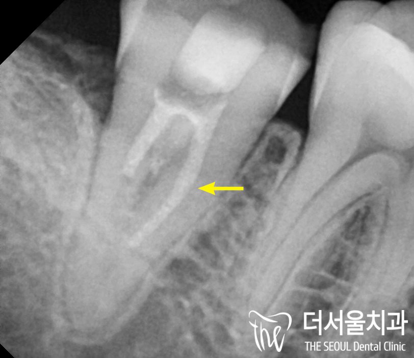 Close-up dental X-ray of a molar during root canal treatment, with an arrow marking the canal being worked on