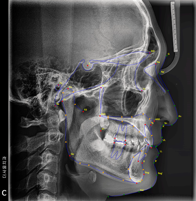 Cephalometric bony landmarks marked on a lateral skull radiograph