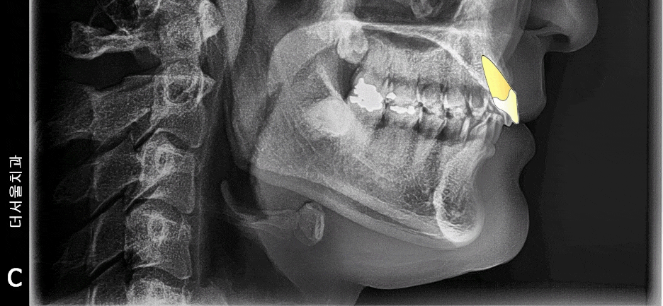 Animation of bodily tooth movement changing inclination and position