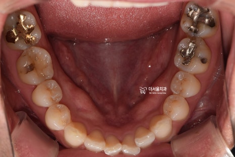Lateral view of the patient's teeth and bite