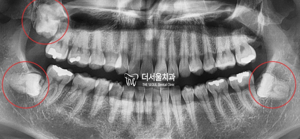 Lateral cephalometric X-ray with the Ricketts esthetic line marked