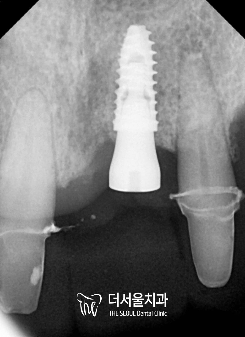 Broken Front Tooth Implant: Removal and Immediate Replacement