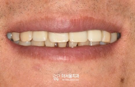 Close-up photograph of the front teeth with the replacement tooth in place