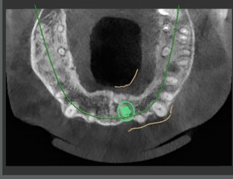 CT cross-section through the upper jaw with the implant site circled in green