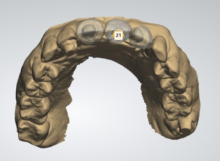 Three-dimensional digital scan of the upper dental arch with the front tooth position marked 21