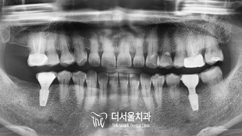 Panoramic dental X-ray taken six years after treatment showing the implants and their crowns still in place