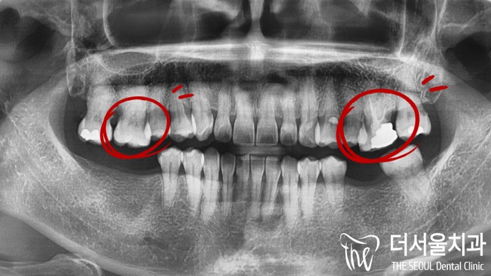 How Long Do Dental Implants Last? A Six-Year Follow-Up