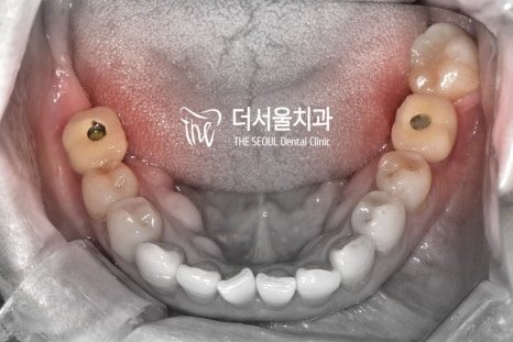 Intraoral photograph of the lower teeth with metal implant abutments visible at the back on both sides