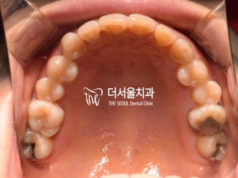 Intraoral photograph of the upper teeth seen from below, with heavily decayed back teeth on both sides