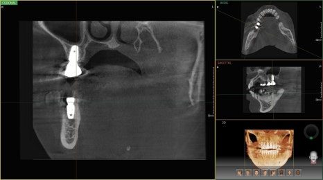 CT scan views of the jaw showing an implant position in cross-section alongside the panoramic and three-dimensional views