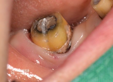 Close-up photograph of a badly decayed back tooth held clear by a green retractor