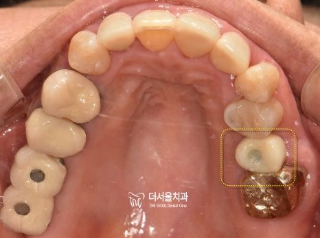 What Digital Implants Actually Do: Less Cutting, Fewer Visits