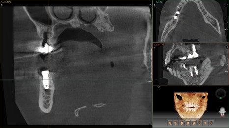 CT cross-section of the jaw with the implant seated in bone, shown next to the matching panoramic slice