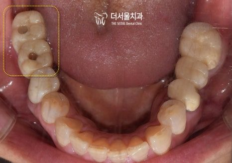 Intraoral photograph of the lower teeth from above after treatment