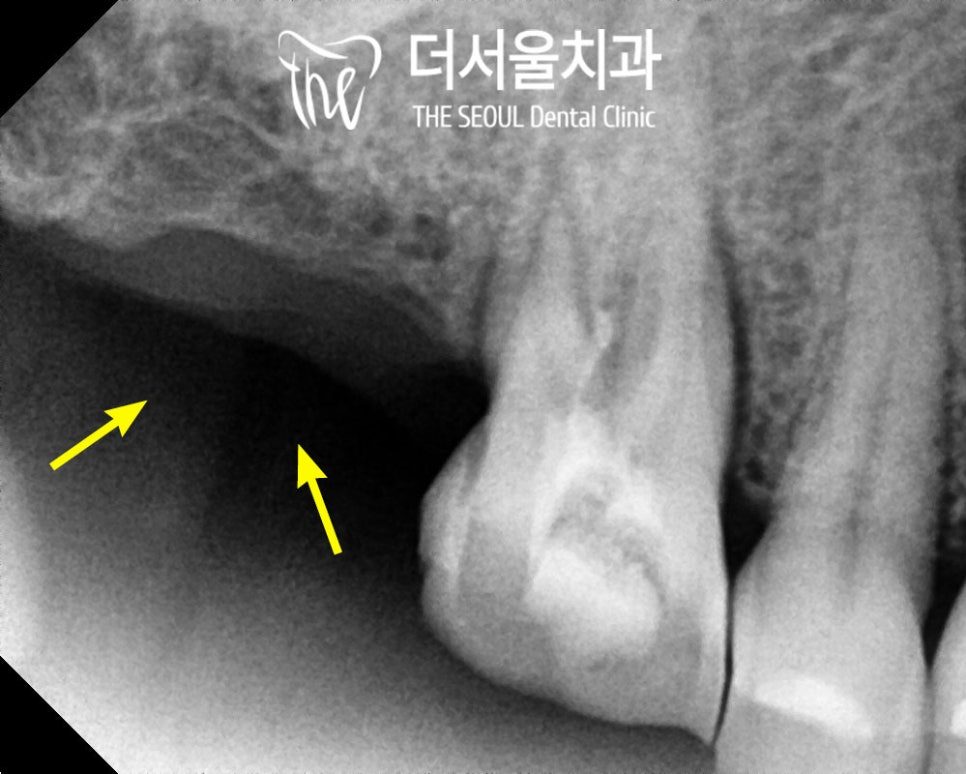 Close-up dental X-ray with yellow arrows pointing at the bone beside a molar root