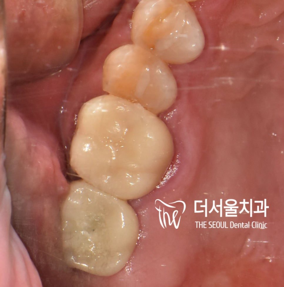 Intraoral close-up of two restored back teeth, one with a gold crown and one tooth-coloured