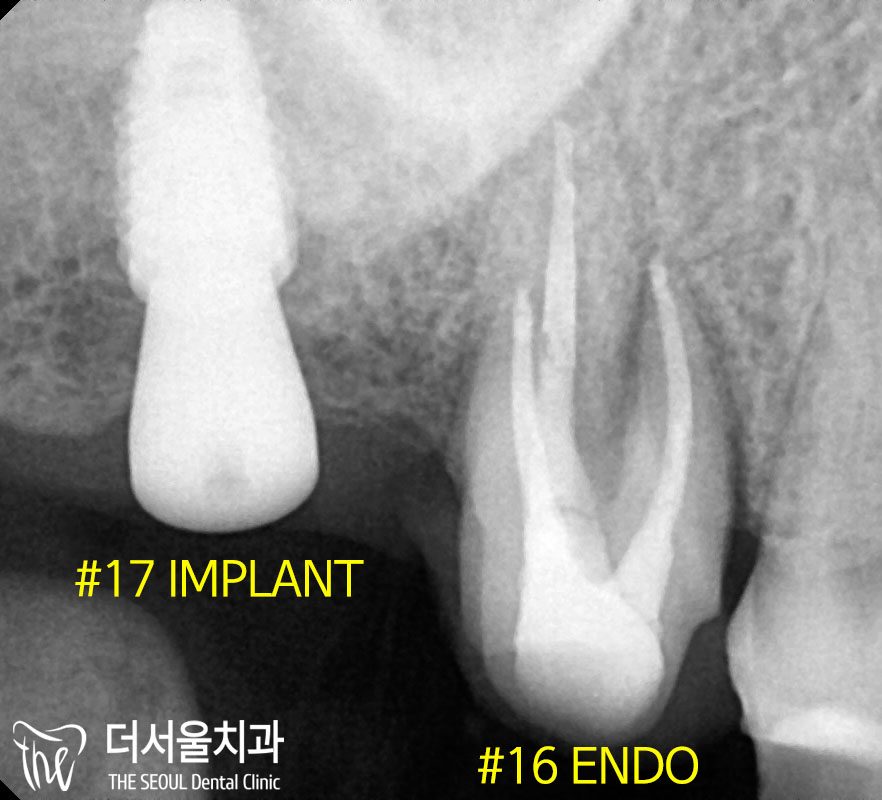 Close-up dental X-ray labelled in English, marking one tooth as an implant and the neighbouring tooth as root-treated