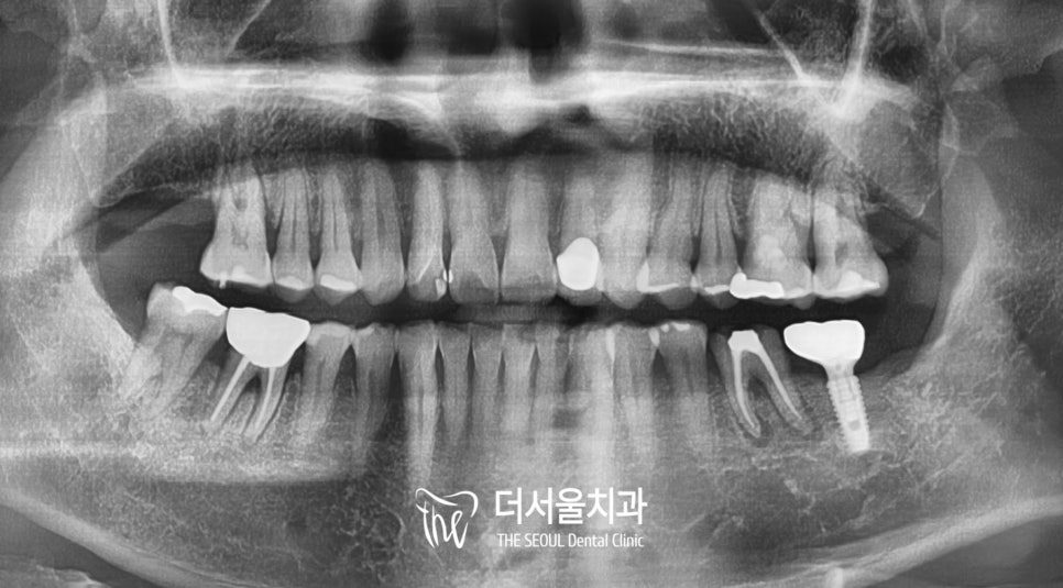 Dental Implant Aftercare: What Actually Decides How Long It Lasts