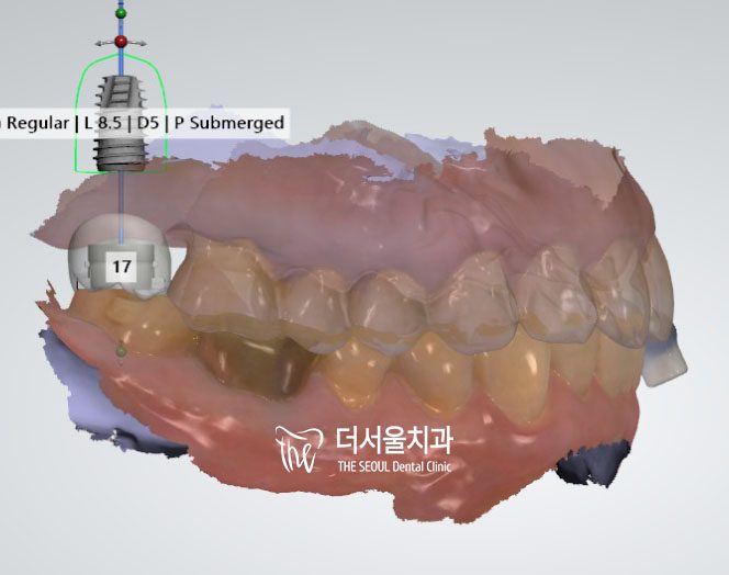 Three-dimensional digital scan of the upper teeth with the planned implant marked and labelled