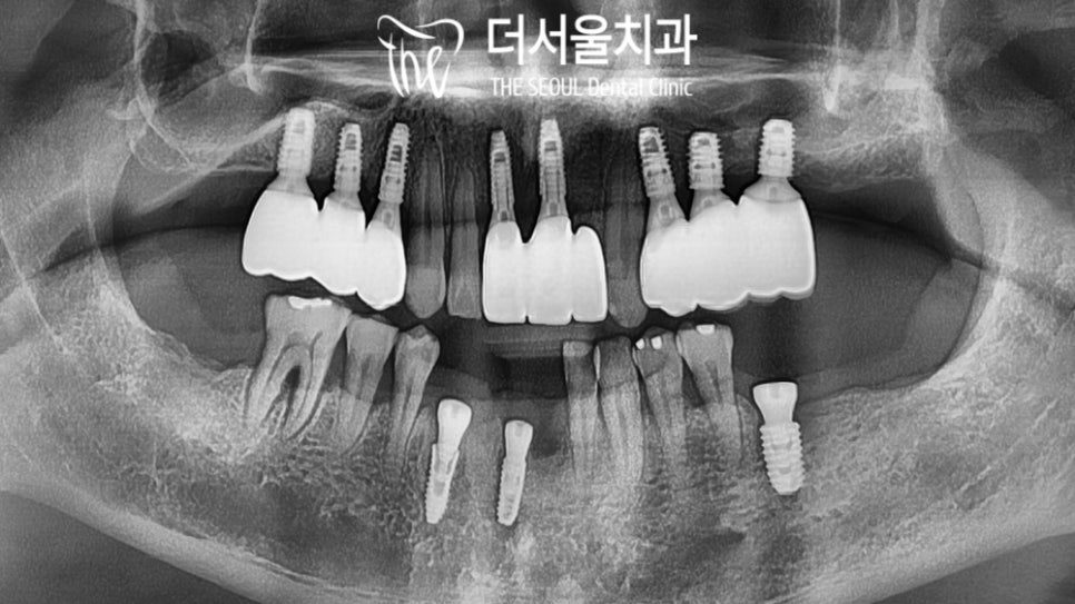 Panoramic dental X-ray showing implant fixtures placed across both jaws before the crowns were made