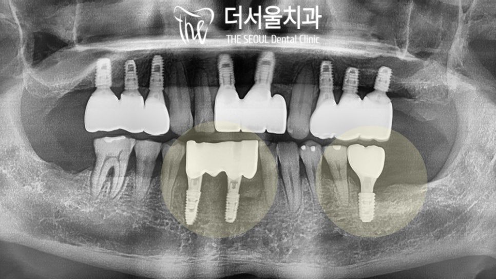 Implants in the Lower Front Teeth: Working in a Narrow Space