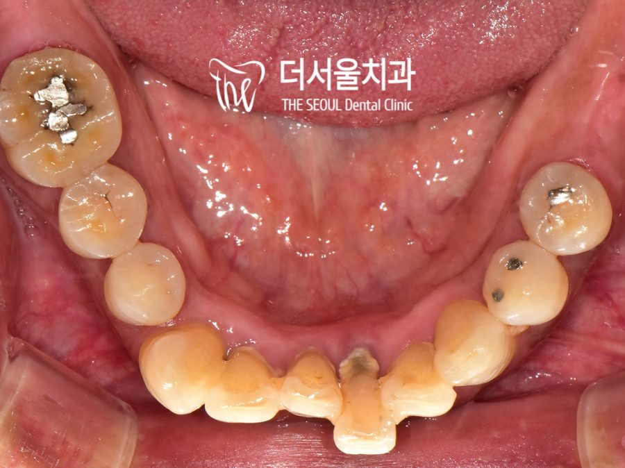 Intraoral photograph of the lower teeth with implant components fitted at the front