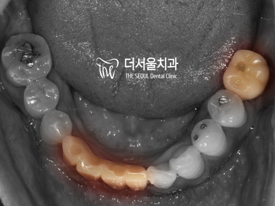 Intraoral photograph of the lower teeth with the finished restorations in place