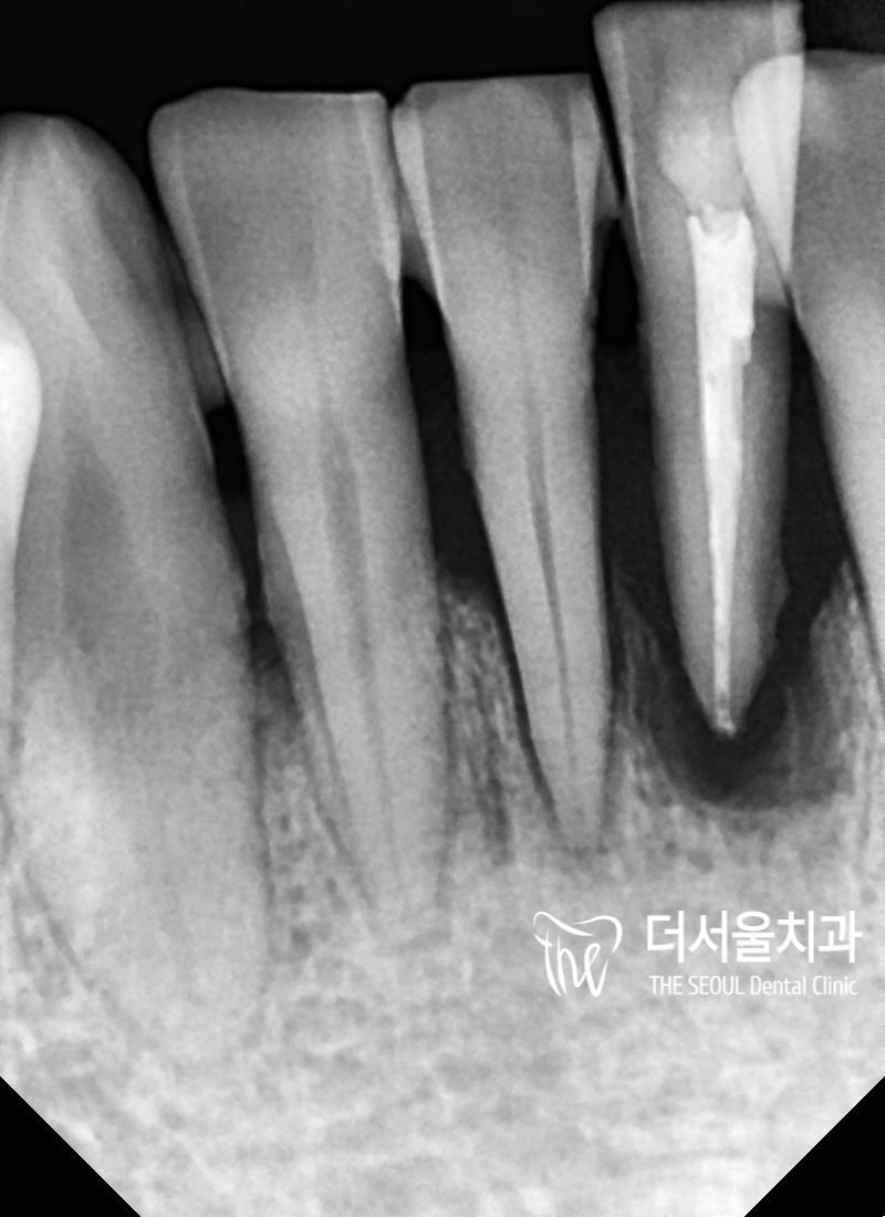 Close-up dental X-ray of the lower front teeth showing how little width there is between the roots