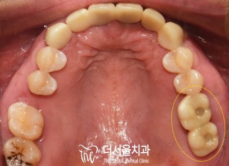 Intraoral photograph of the upper teeth from below with the back teeth on one side circled